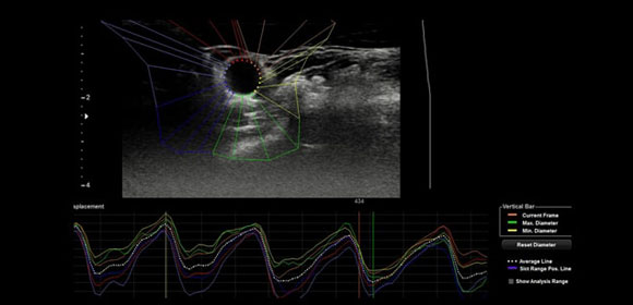 arterial-analysis